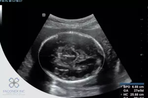 OFD Ultrasound What It 2