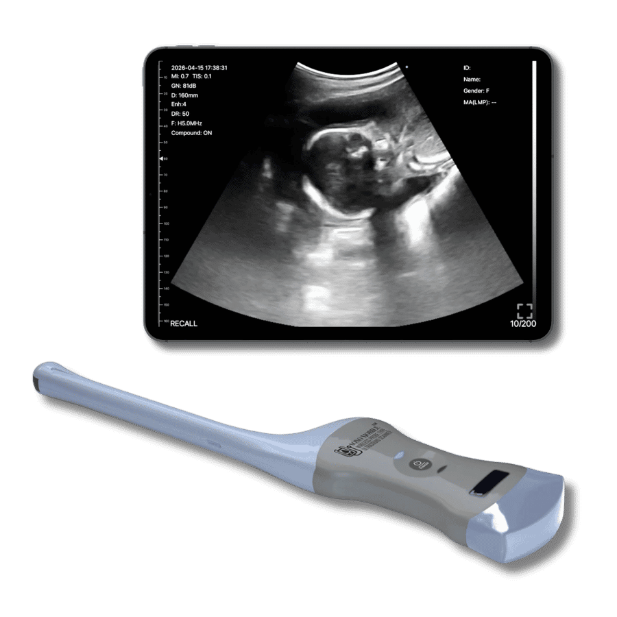 Fetal ultrasound scanning with Sono Mobile CT61 handheld device displayed on tablet, showing obstetric imaging in clinical setting