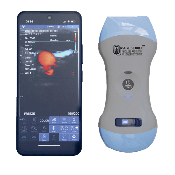 handheld ultrasound