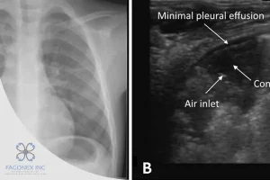 Ultrasound VS X-Ray