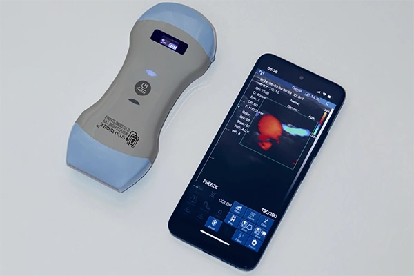 The Role of Sono Mobile™ in Early Pregnancy Scans