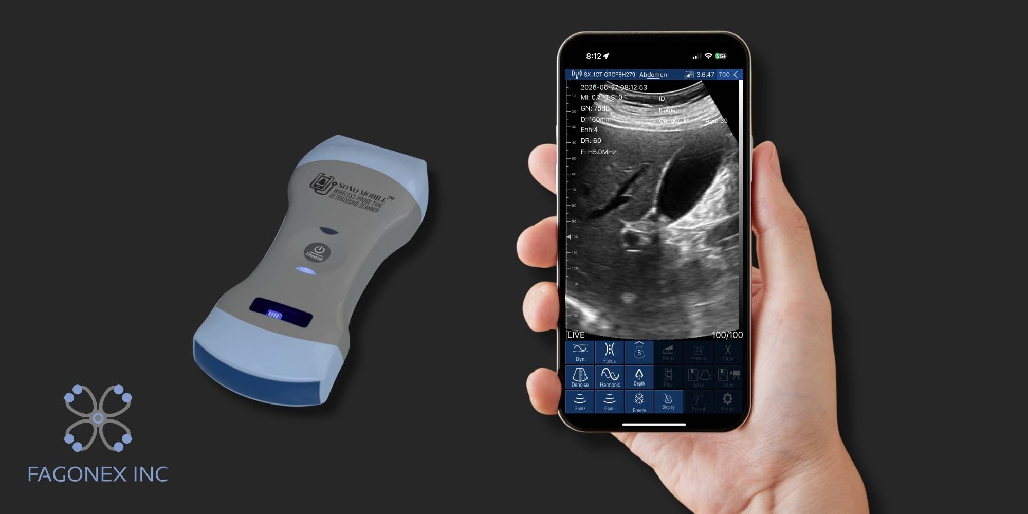 Mobile ultrasound device connected to a smartphone for real-time handheld imaging and point-of-care diagnostics.
