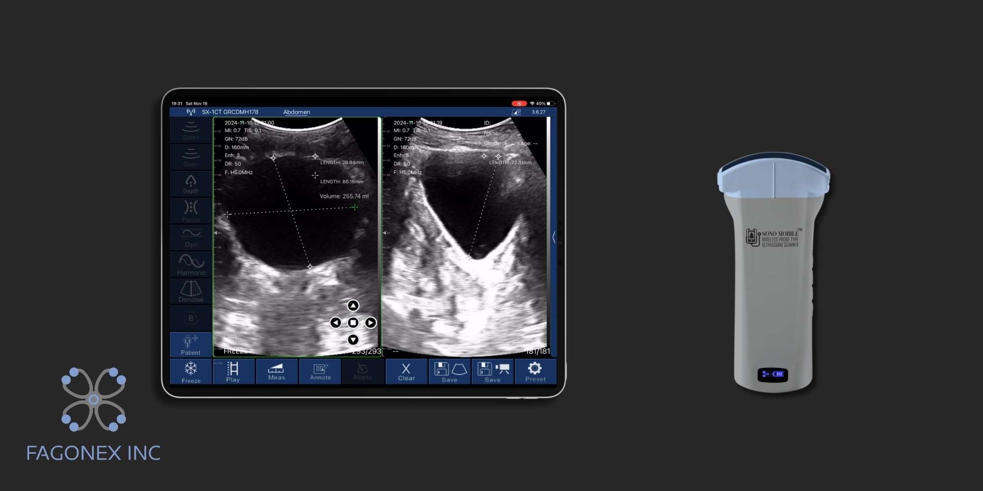 Sono Mobile™ bladder volume calculation on a tablet