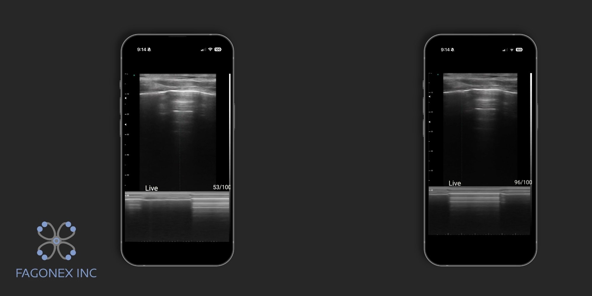 Lung point and lung sliding assessment on M-mode using Sono Mobile™ ultrasound
