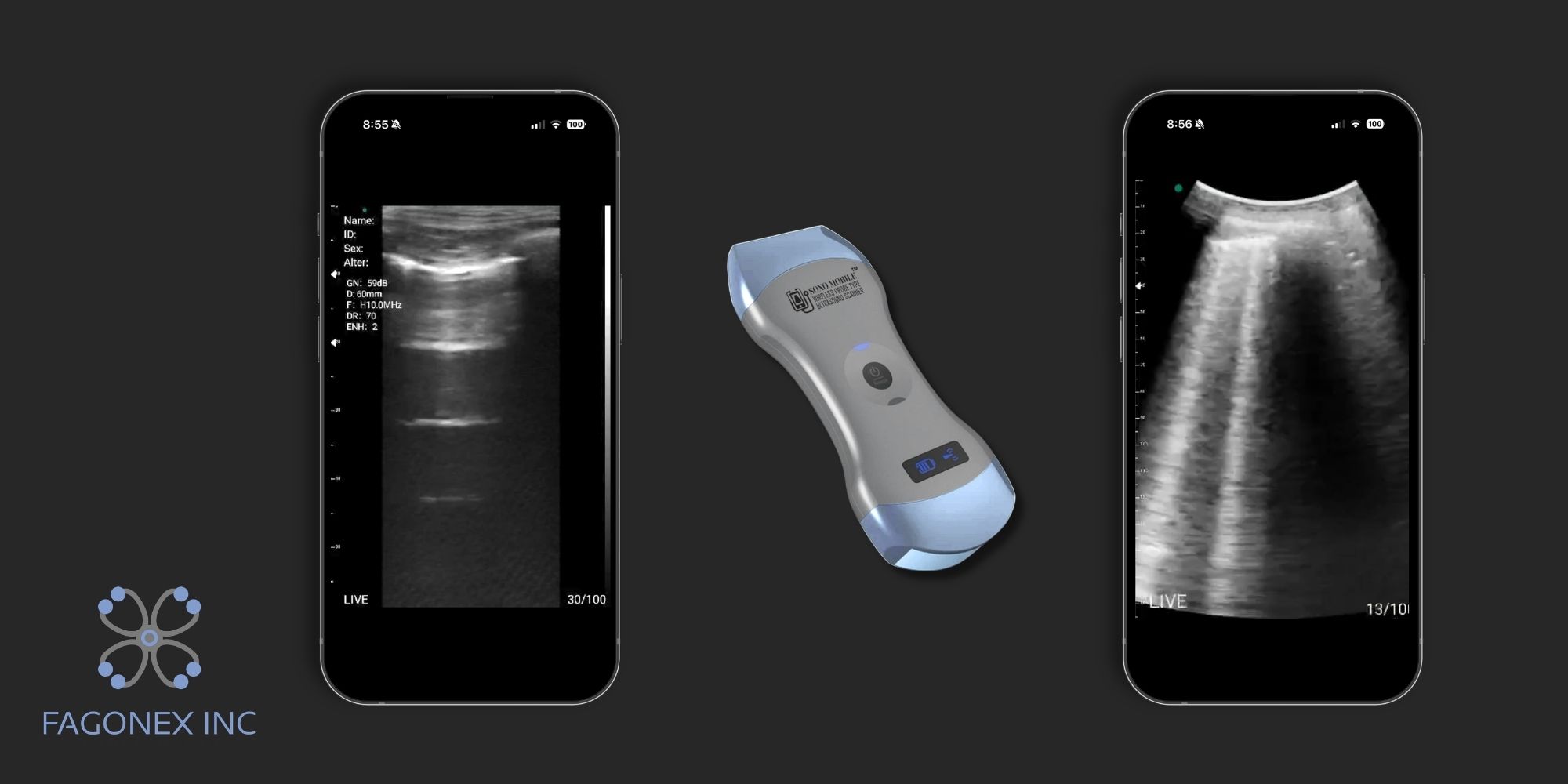 Pulmonary A-line and B-line assessment using Sono Mobile™ dual head ultrasound