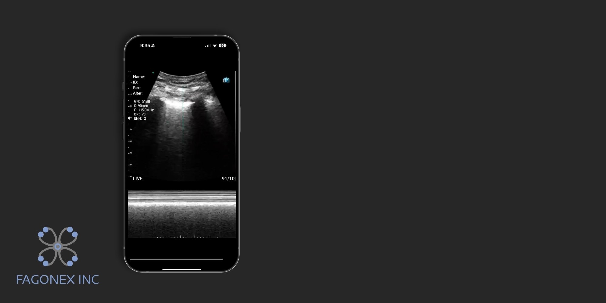 Normal seashore sign on lung ultrasound M-mode