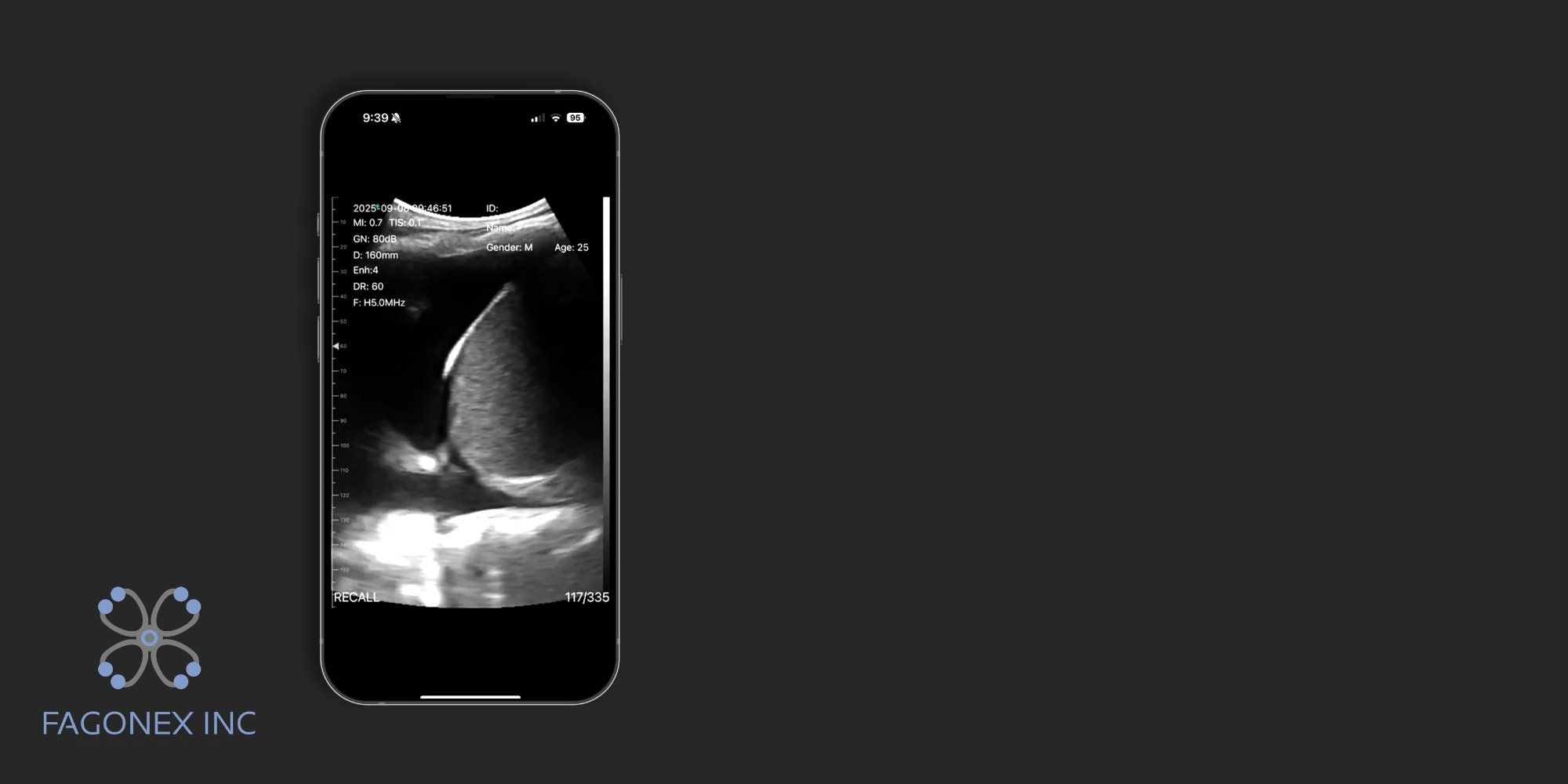 Pleural effusion detected using Sono Mobile™ handheld ultrasound