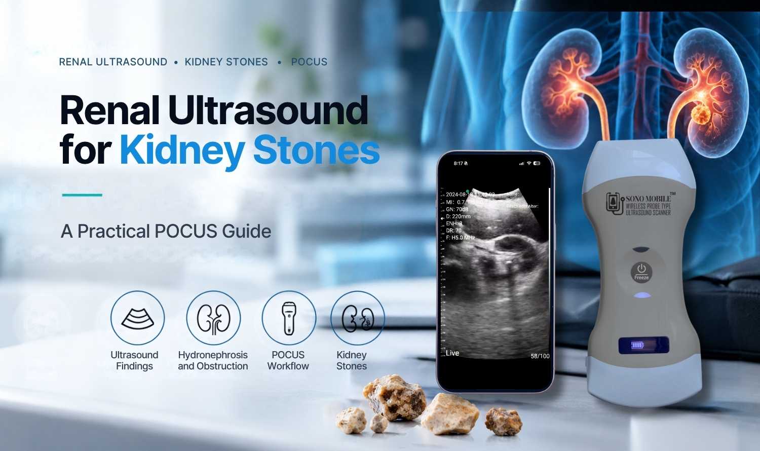 Renal ultrasound for kidney stones using handheld ultrasound