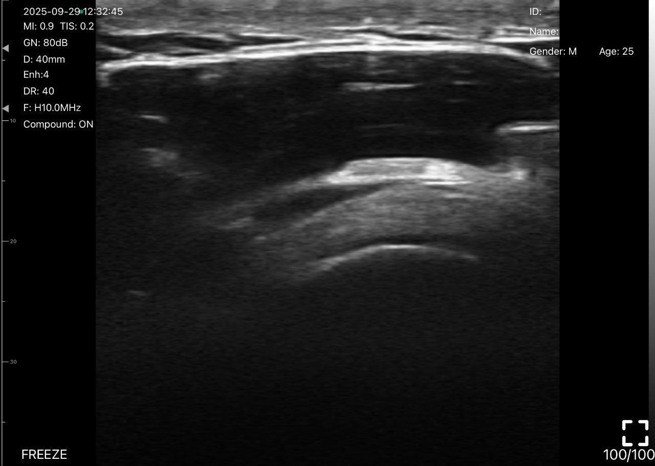 Shoulder rotator cuff tear ultrasound educational image